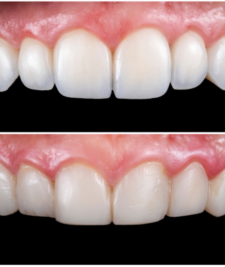 lente de contato dental antes e depois